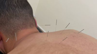 Acupuncture